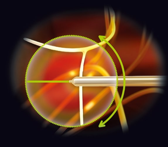 運動神経を避けつつ、ターゲットとなる知覚神経を広範囲に焼灼します。