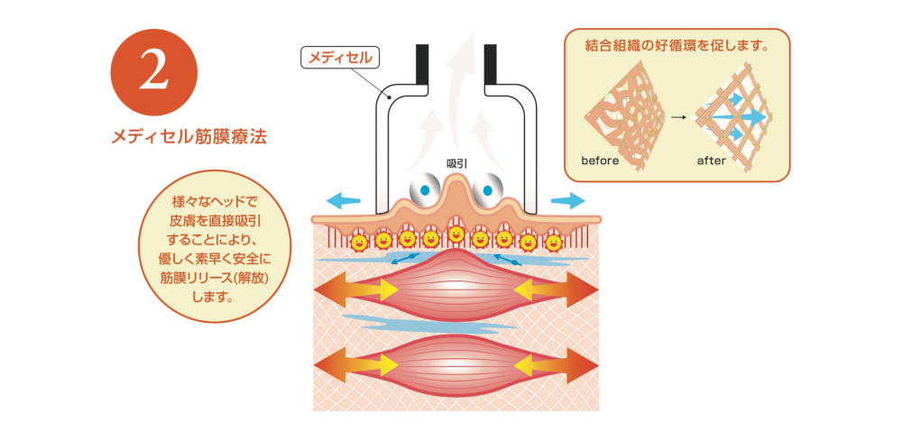メディセル筋膜療法